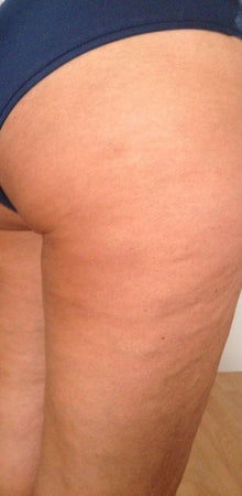 After - Las imperfecciones de la piel no solo se ven, también se sienten.