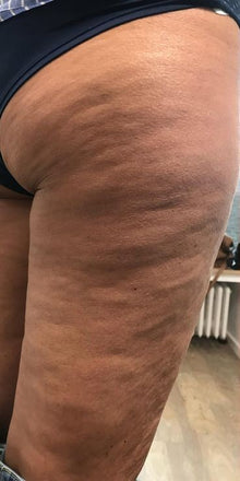 Before - Las imperfecciones de la piel no solo se ven, también se sienten.